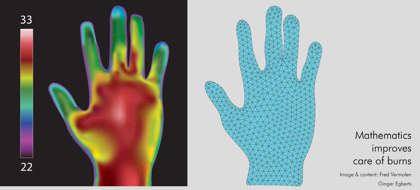 A modelling of a burned hand