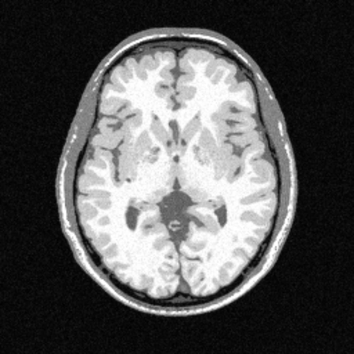 MRI image of a brain